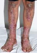 zinc deficiency