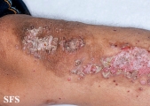zinc deficiency