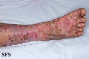 zinc deficiency