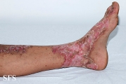 zinc deficiency