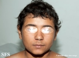 zinc deficiency