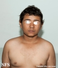 zinc deficiency