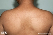 zinc deficiency