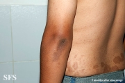 zinc deficiency