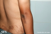 zinc deficiency