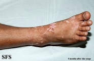 zinc deficiency