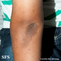 zinc deficiency