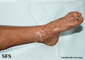 zinc deficiency
