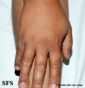 zinc deficiency