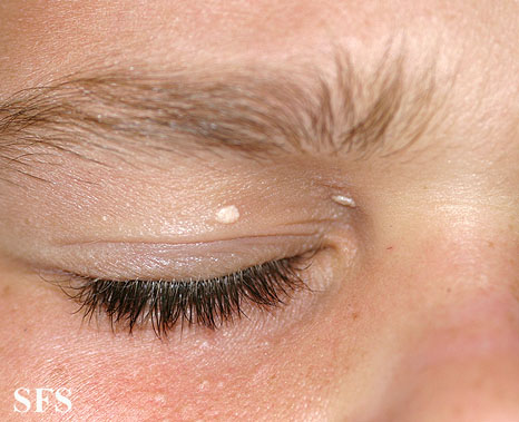 calcinosis cutis face