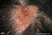 naevus sebaceous