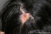 naevus sebaceous