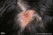 naevus sebaceous