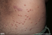 xanthoma eruptive