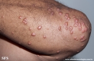 xanthoma eruptive