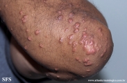 xanthoma eruptive