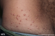 xanthoma eruptive