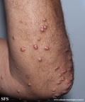 xanthoma eruptive