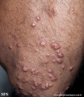 xanthoma eruptive