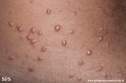 xanthoma eruptive