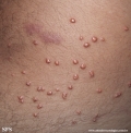 xanthoma eruptive