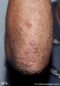 xanthoma eruptive