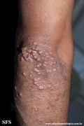 xanthoma eruptive