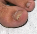 chondroma