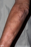 leprosy borderline