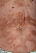 leprosy borderline