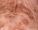 leprosy borderline