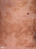 leprosy borderline