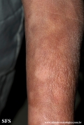 leprosy borderline