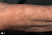 leprosy borderline