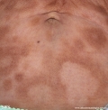leprosy borderline