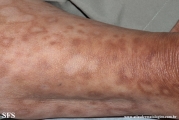 leprosy borderline