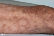 leprosy borderline