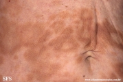 leprosy borderline