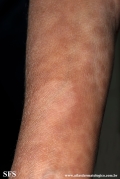 leprosy borderline