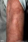 leprosy borderline