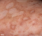 leprosy borderline