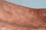 leprosy borderline