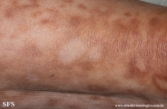 leprosy borderline