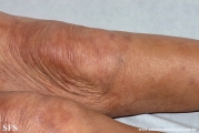 leprosy borderline