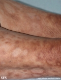 leprosy borderline