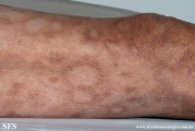 leprosy borderline