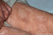 leprosy borderline