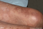 leprosy borderline