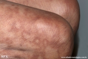 leprosy borderline