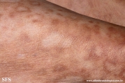 leprosy borderline